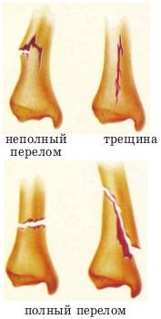 Первая помощь при ушибе скелета